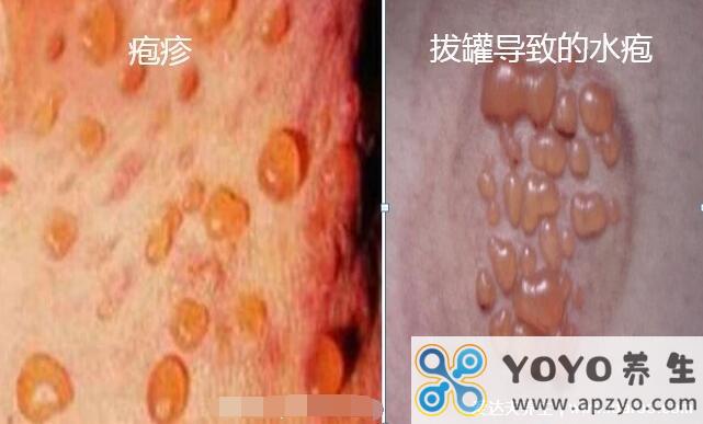 水泡和疱疹的区别图片